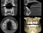 Fig 8. CBCT evaluation was used to facilitate proper planning and treatment.