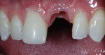Fig 9. Soft tissue was molded with a provisional restoration. Note that the gingival contour emergence profile from the implant preserved and maximized the soft tissue in the mouth.