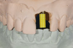 Fig 10. The laboratory evaluates the analog for the implant abutment on the model from facial and occlusal views.