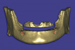 Figure 7  Interactive software allows for virtual sectioning of the anterior mandible to achieve adequate width for implant placement.
