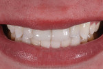 Fig 26. The patient’s smile with the final restorations.