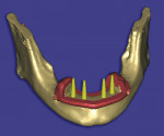Figure 9  A bone reduction template provides an intraoperative guide for the removal of bone.