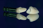 Figure 11  A custom CAD/CAM zirconia abutment on an implant analog, with the final zirconia crown.