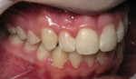 Figure 10  Postoperative retracted lateral view shows the dramatic increase in symmetry achieved with this short-term orthodontic solution.