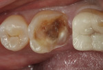 Figure 3  Recurrent decay under a previously placed restoration was removed. Affected dentin was cleaned with 2% chlorhexidine (CAVITY CLEANSER, BISCO). Asymptomatic, near proximity to the pulp requiring protective indirect pulp-capping. TheraCal LC