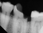 Figure 4  Recurrent decay under a previously placed restoration was removed. Affected dentin was cleaned with 2% chlorhexidine (CAVITY CLEANSER, BISCO). Asymptomatic, near proximity to the pulp requiring protective indirect pulp-capping. TheraCal LC