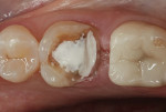 Figure 5  Recurrent decay under a previously placed restoration was removed. Affected dentin was cleaned with 2% chlorhexidine (CAVITY CLEANSER, BISCO). Asymptomatic, near proximity to the pulp requiring protective indirect pulp-capping. TheraCal LC