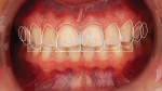 The design process was begun by the dentist using clinical images overlaid with templates to assist in achieving ideal proportions and
incisal edge positions.