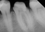 Figure 6  Recurrent decay under a previously placed restoration was removed. Affected dentin was cleaned with 2% chlorhexidine (CAVITY CLEANSER, BISCO). Asymptomatic, near proximity to the pulp requiring protective indirect pulp-capping. TheraCal LC