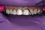 Isolation was achieved using a slit rubber dam, and retraction cord was placed to displace the tissue and prevent the prepared enamel surfaces from becoming contaminated with sulcular fluid.