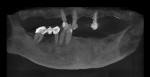 Fig 2. Preoperative radiograph. The patient’s remaining teeth were Nos. 6, 8, 12, 27, 28, 29, and 31. Caries was present on teeth Nos. 6M, 8M, 12M, and 27. Tooth No. 12 had root canal treatment.