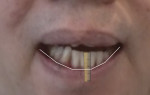 Fig 8. Using a screenshot of the video of the patient speaking, the lower lip movement was shown to be 8 mm.