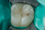 Figure 1  The patient was anesthetized using a 2% lidocaine block, and a non-latex dam was placed on tooth No. 30.
