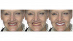 From left to right: the existing denture appearance, the superimposed digitized denture, and the redesigned digital denture visualization in CAD software (NemoStudio, NemoTec).