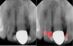 Fig 2. Class 3 carious lesion detection by machine learning algorithms trained to specifically detect both primary and secondary decay on anterior teeth is shown. In the image on the right, recurrent decay can be seen in red on the mesial of teeth Nos. 7 and 9, with primary decay detected on the distal of No. 7. (Source: Overjet, Inc.)