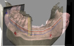 Fig 12 through Fig 14. By merging the photograph showing the patient speaking, intraoral scan, and CBCT scan of the mandible, the planning of implant placement in the mandible was started.