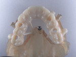 Fig 17. The hybrid provisional guide would be placed over the base guide after implant placement and bonded to the temporary abutment.