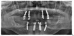 Fig 18. Postoperative radiograph after maxillary and mandibular All-on-4 implant placement.