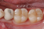 Figure 7  The patient presented with recurrent decay and rough contours on teeth Nos. 30 and 31.