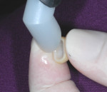 Fig. 2 through Fig 4. To maximize adhesion to zirconia when using a resin cement the intaglio surface should be sandblasted and treated with a zirconia primer (Fig 2). In this case, the primer was dried with a warm-air drier (Fig 3) prior to the placement of a dual-cure resin-cement (Fig 4). If the cement already contains a zirconia primer, such as 10-MDP, a separately applied primer may not be necessary.