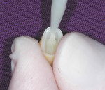 Fig. 2 through Fig 4. To maximize adhesion to zirconia when using a resin cement the intaglio surface should be sandblasted and treated with a zirconia primer (Fig 2). In this case, the primer was dried with a warm-air drier (Fig 3) prior to the placement of a dual-cure resin-cement (Fig 4). If the cement already contains a zirconia primer, such as 10-MDP, a separately applied primer may not be necessary.