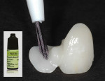 Fig 5. When there is a lack of resistance and retention form, as in this single-wing zirconia resin-bonded bridge, the intaglio surface may be sandblasted, treated with a zirconia primer, and bonded into place with resin cement.