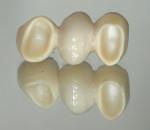 Fig. 9 through Fig 12. When good resistance and retention form are present, zirconia restorations do not require bonding. After sandblasting, they can be placed with ion-releasing cements. Fig 9: Preparations for a three-unit fixed partial denture that demonstrate good resistance and retention form. Fig 10: Monolithic zirconia restoration with ovoid pontic. Fig 11: The case was cemented with a conventional RMGI. Fig 12: The finished case immediate post cementation.