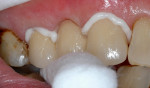 Fig. 9 through Fig 12. When good resistance and retention form are present, zirconia restorations do not require bonding. After sandblasting, they can be placed with ion-releasing cements. Fig 9: Preparations for a three-unit fixed partial denture that demonstrate good resistance and retention form. Fig 10: Monolithic zirconia restoration with ovoid pontic. Fig 11: The case was cemented with a conventional RMGI. Fig 12: The finished case immediate post cementation.