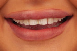 Fig 2. Preoperative close-up smile photograph.