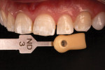 Fig 7. Preoperative shade tab photographs were taken of each tooth to assist the technician with ingot selection.
