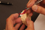 Fig 10. After the interproximal contacts were refined, the restorations were seated on a solid model.