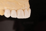 Fig 16. Incisal opal effect and bleach enamel powders were layered full contour on the remaining incisal one-third of the facial cutback.