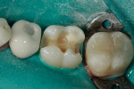 Figure 12  After blending the composite into the margins and smoothing to eliminate voids, the restoration was light-cured. After removing the tofflemire band, the restoration was light-cured, shaped, and contoured.