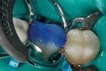 Figure 13  A sectional matrix system was placed for tooth No. 30, and the same procedure was performed.