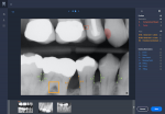 Fig 2. Example of a clinical intelligence dashboard utilizing AI: a bitewing radiograph that is processed in real-time to support diagnoses by a dentist and findings review with the patient. Findings could include, but are not limited to, a compromised margin on a restoration, caries, bone loss depths, and calculus. Source: Overjet Inc.