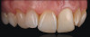 Figure 3  Panoramic radiograph shows a multilocular radiolucency extending from the left second molar to the right first molar.