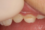 Fig. 1. Facial caries on tooth No. H in a 6-year-old patient.