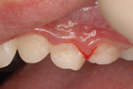 Fig. 2. Post-caries removal, application of CAVITY CONDITIONER, EQUIA Forte, and EQUIA Forte Coat.