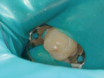 Fig. 4. Caries on the distal pit of tooth No. J.