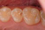 Fig. 7. Tooth No. 4 treated with a DO slot preparation.