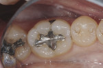 Fig. 1. Preoperative view of defective Class I and Class V amalgam filling in mandibular right first molar (tooth No. 30).