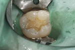 Fig. 2. Rubber dam was applied, defective fillings removed, and final Class I and Class V cavity preparations completed.