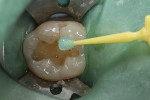 Fig. 3. Cavity preparations were cleaned with 20% polyacrylic acid (Cavity Conditioner, GC America) for 10 seconds and rinsed with water.