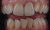 Figure 9  Dental protrusion with incisor irregularity and a dual plane of occlusion.