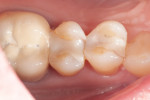 Fig. 9. Preoperative view of defective MOD composite resin restoration in maxillary right second premolar (tooth No. 4).