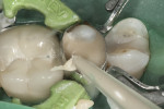 Fig. 12. Second-generation high-viscosity glass restorative material (EQUIA Forte Fil) was injected into the prepared cavity.