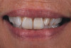 Figure 11  The esthetic occlusal plane and amount of incisor display were established.