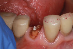 Close-up buccal view of broken-down tooth No. 28 following root canal therapy.