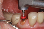 A drill was used to remove the endodontic filling material to the ideal depth.