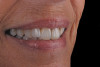 Figure 13  Implant-supported transitional prosthesis extended to second molars.